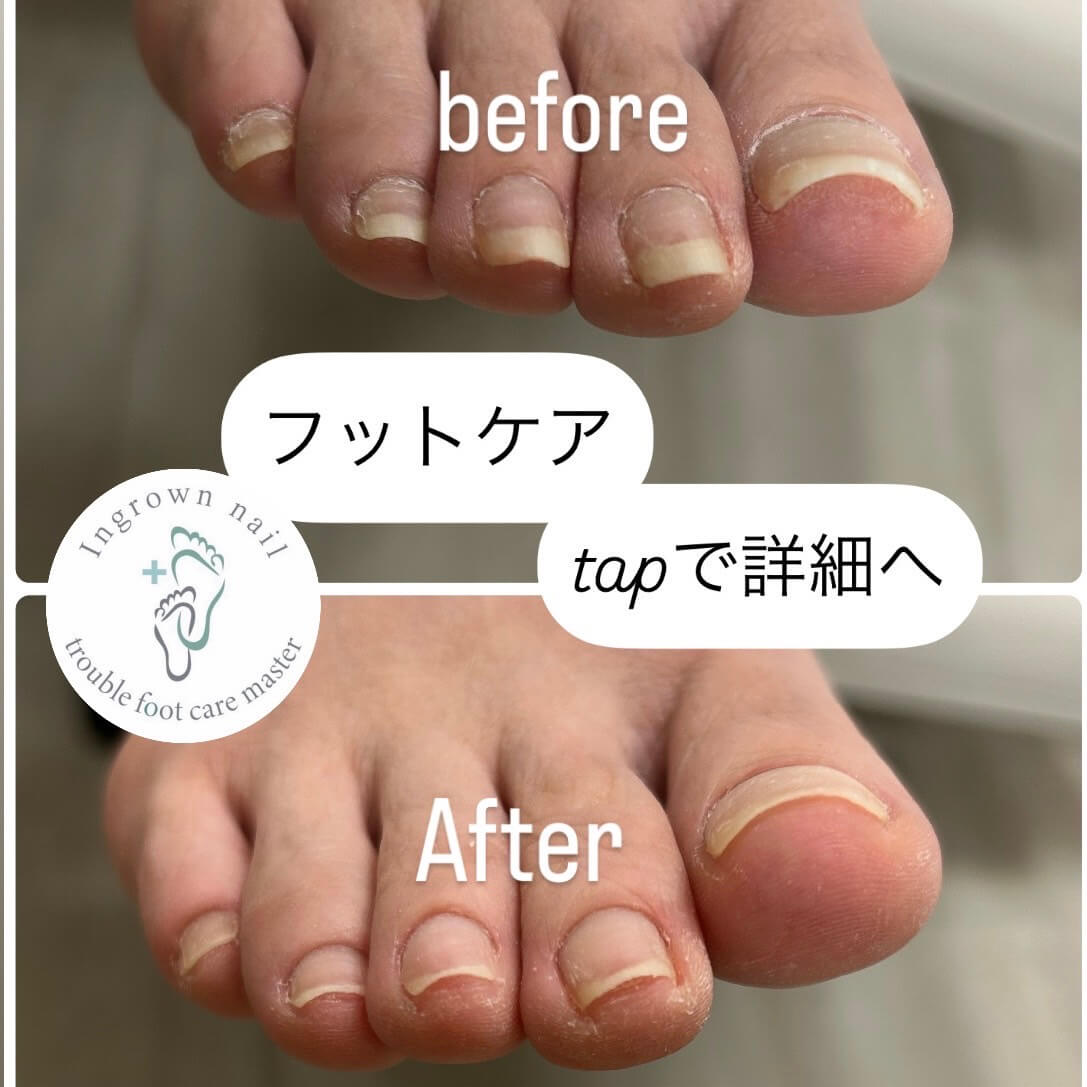 フットケア