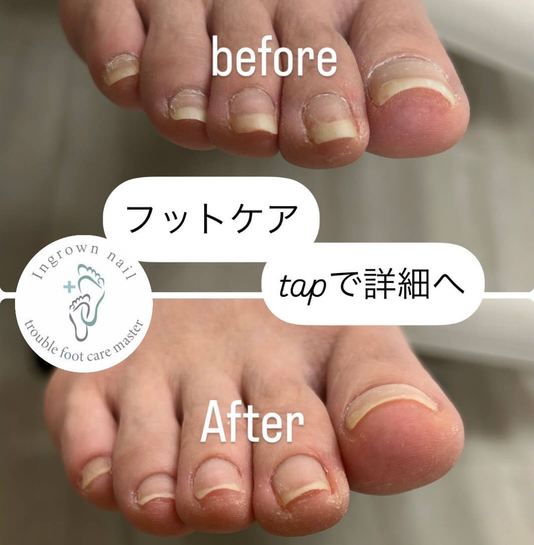 フットケア