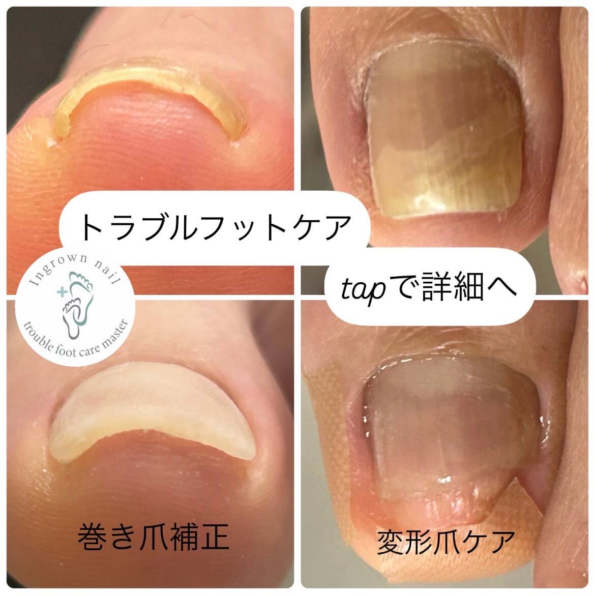 トラブルフットケア