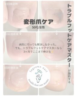 ずっとこのままかと思っていた爪。
3ヶ月後、伸びてきました🥰👣✨
.
いつもホームケアをコツコツと
頑張っていただいてる成果も見えます🫶🏻
.
このペースだと、卒業まであと半年くらい😊✨
一緒に頑張りましょう~🔥🩵
.
#トラブルフットケア
#トラブルフットケアマスター
#変形爪
#梨ネイル