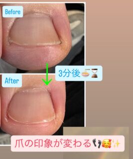 爪が食い込んで痛い~😭💦
.
でもどこに相談したら良いかわからない😣
そんな方も大丈夫🫶🏻
.
トラブルフットケアマスターによる正しい爪切りで、
食い込みを除去し、爪の印象も変わります🦶🏻✨
.
日々体を支えている足🦶🏻
フットケアして労わりましょ~🥰✨
.
.
#フットケア
#ボンマルシェ
